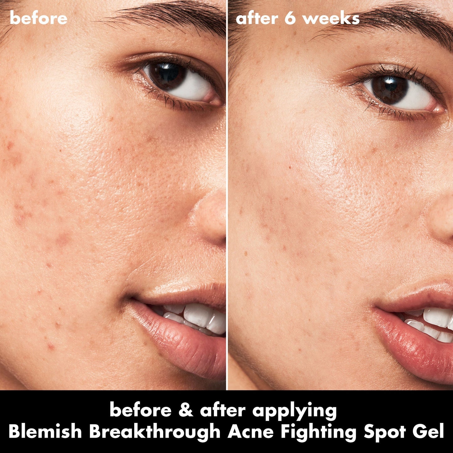 blemish-breakthrough-acne-fighting-spot-gel-y2 0326_EDU_BB_SpotGel_BA_ISABELLA.jpg