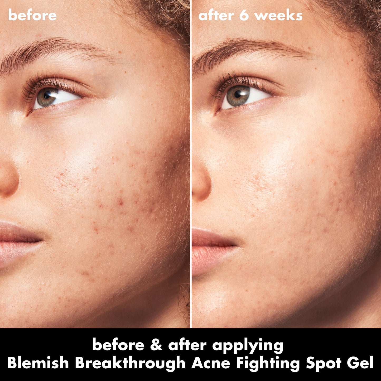 blemish-breakthrough-acne-fighting-spot-gel-y2 0326_EDU_BB_SpotGel_BA_MARLEY.jpg