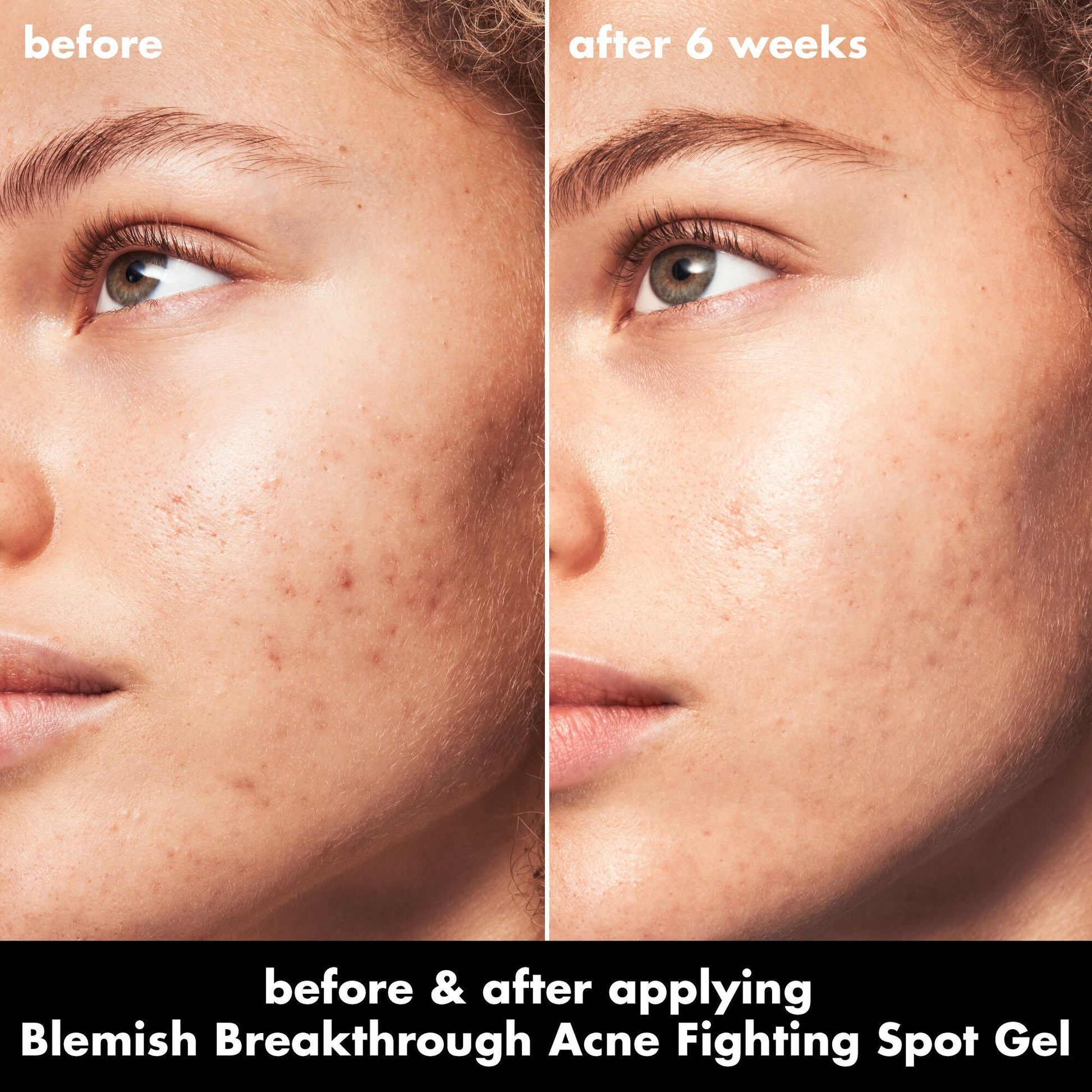 blemish-breakthrough-acne-fighting-spot-gel-y2 0326_EDU_BB_SpotGel_BA_MARLEY.jpg