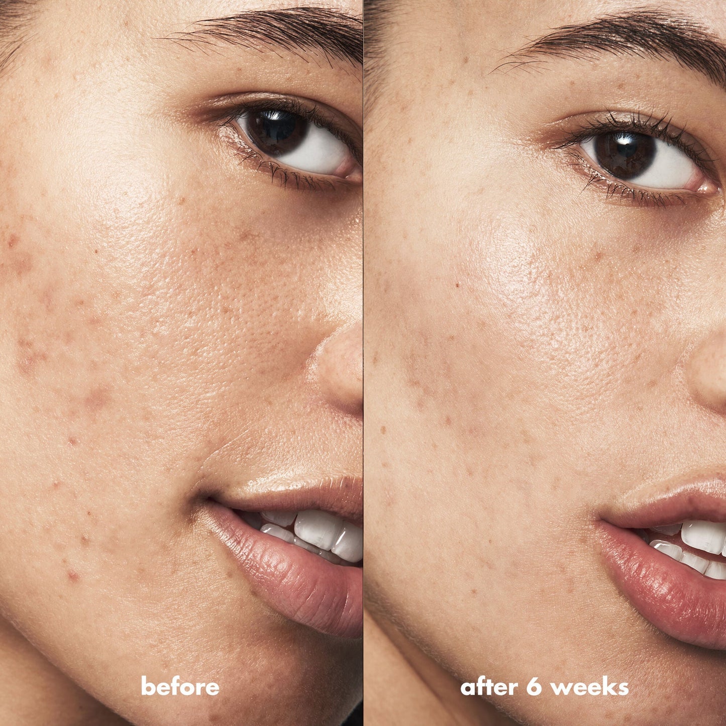 blemish-breakthrough-triple-acid-resurfacing-serum-p3 Acne_PDP_Isabella_Before_After_b8fe0505-ae5c-4baa-9a8e-fd889e4c3414.jpg