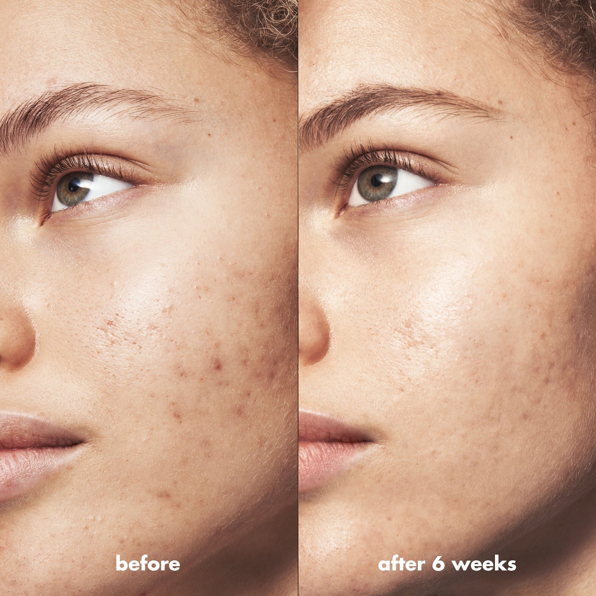 blemish-breakthrough-acne-calming-water-cream-c4 Acne_PDP_Marley_Before_After_be0f6ee7-ce12-4695-83d7-5ec5f0498e19.jpg